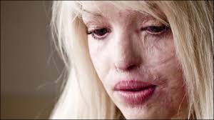 Brave Face: Katie Piper - courage after a brutal acid attack. To play this content JavaScript must be turned on and the latest Flash player installed. - 091028131834_katie_piper_1