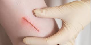 Proses penyembuhan luka terdiri dari 3 (tiga) fase. Luka Lambat Sembuh Apakah Punca Ia Boleh Terjadi