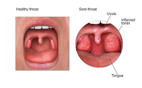 sore throat community antibiotic use cdc