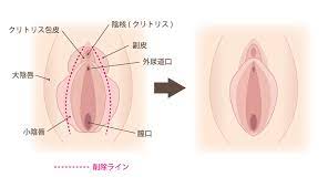 小陰唇縮小術 | 費用・術後の痛みについて | y's clinic ワイズクリニック | 大阪心斎橋の美容皮膚科・美容外科・美容クリニック