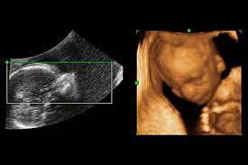 May 19, 2021 · those who forgo the six to eight week ultrasound might have adating ultrasound around weeks 10 to 13 of pregnancy. Pregnant Women Get More Ultrasounds Without Clear Medical Need Wsj
