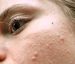 Small Bumps On Face Not Acne White Bumps On Face Pimples On Face Small Bumps On Face