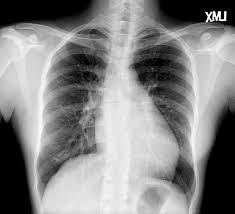Chest X Ray Shows Cardiomegaly Cardiothoracic Ratio 52 Download Scientific Diagram