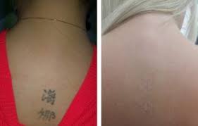 Laser treatments (ipl) for acne, red veins, unwanted hair, pigmentation, sun damage and skin rejuvenation Investigaciones Metabolicas Download 24 Tatouage Under Boots Prix