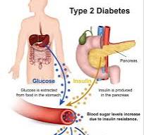 Understanding Type 2 Diabetes - Harmony Endorine