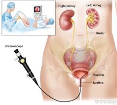 Taking steps to improve your health may help reduce your risk of kidney cancer. Transitional Cell Cancer Of The Renal Pelvis And Ureter Treatment Pdq Treatment Patient Information Nci Michigan Medicine