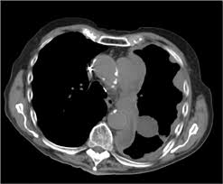 A bone marrow biopsy demonstrated infiltrative malignant mesothelioma lesions in the bone marrow. Localized Malignant Mesothelioma An Unusual And Poorly Characterized Neoplasm Of Serosal Origin Best Current Evidence From The Literature And The International Mesothelioma Panel Modern Pathology