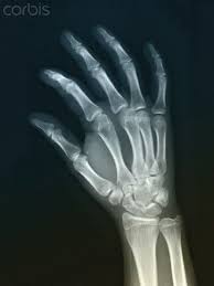 Normal Hand X Ray Of An 18 Year Old Girl Photo Royalty Free Photos Stock Photography