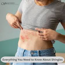 Image result for shingles