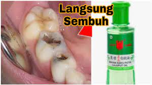 Gusi bengkak tidak hanya dapat menimbulkan ketidaknyaman pada mulut, tapi juga kerusakan pada jaringan dan tulang yang menopang gigi jika diabaikan. Mengatasi Gusi Bengkak Dan Sakit Gigi