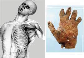 Fijalkowska m* and antoszewski b. Poland S Syndrome Thoracic Key