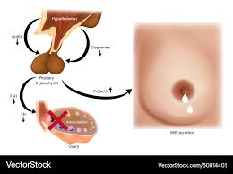 Image result for Hyperprolactinemia