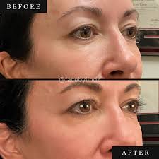 ✨ Scarlet SRF: The Ultimate Skin Tightening Treatment ✨ Just look at these  **stunning** before-and-afters! With **Scarlet SRF**, we've achieved  incredible improvements in skin **tightness, texture, and lift**—especially  around the **under eyes