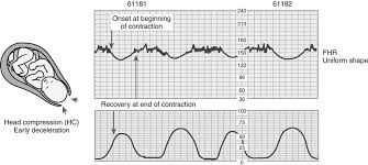 Image result for Early Deceleration