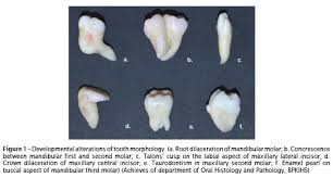 Icd-10-Cm Diagnosis Code K00.1 - Supernumerary Teeth