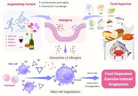Image result for Exercise-Induced Anaphylaxis