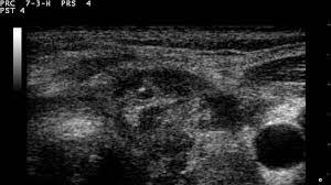 Ultrasounds are usually quick and most don't require special preparation. Neck Lump Pictures Causes Associated Symptoms And More