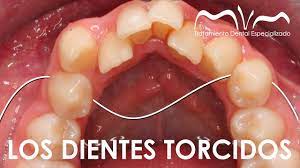 Por Que Nos Salen Los Dientes Torcidos Apinamiento Dental Youtube