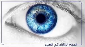 المياه الزرقاء في العين أسبابها وعلاجها تركي ويز