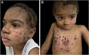 Case for diagnosis. Disseminated erythematous and scaly plaques: chronic  mucocutaneous candidiasis