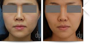 Page Not Found 404 Botox Botox Before And After Botox Injections