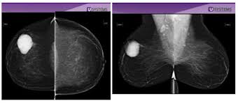 The radiologist looks for evidence of cancer or noncancerous (benign) conditions that may require. Breast Density And Breast Cancer Gw Hospital