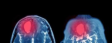 A ruptured brain aneurysm is a medical emergency and the clinical team will move quickly. Unruptured Brain Aneurysms Johns Hopkins Medicine