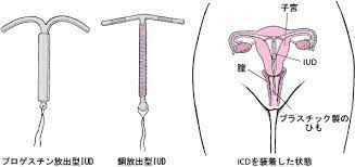 避妊リング（iud）とは iud（inter uterine device：子宮内避妊用具）は、子宮内に避妊目的で挿入する小さな器具です。 以前は、丸型のものが多かったので、現在でも通称「リング」と呼ばれます。 å­å®®å†…é¿å¦Šå™¨å…· Iud 22 å¥³æ€§ã®å¥åº·ä¸Šã®å•é¡Œ Msdãƒžãƒ‹ãƒ¥ã‚¢ãƒ«å®¶åº­ç‰ˆ