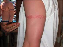 How is paraphenylenediamine allergy diagnosed? Allergic Contact Dermatitis To Paraphenylendiamine In Hair Dye After Sensitization From Black Henna Tattoos A Report Of 6 Cases Cmaj