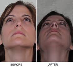 Septoplasty Before And After Yahoo Search Results Liposuction Rhinoplasty Plastic Surgery