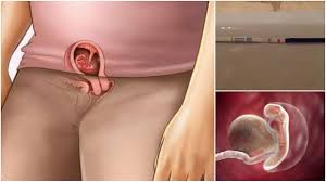 Bagi anda yang ada tumor fibroid/kulit berlebih di tubuh, begini cara menghilangkannya tumor fibroid sebagian besar terjadi pada orang paruh baya pada daerah leher, ketiak, perut, bawah payudara, kelopak mata dan bagian tubuh lainnya. Contoh Keputihan Tanda Hamil 1 Minggu Dan Ciri Ciri Tanda Awal Kehamilan Wajibbaca