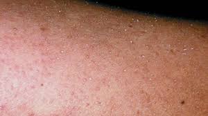 Causes Of Red Bumps And Spots On Legs Keratosis Pilaris Diet Keratosis Pilaris Red Spots On Legs