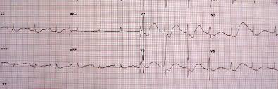 Image result for Hyperkalemia