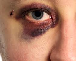 5 Cosas Que Debe Saber Sobre Un Ojo Negro American Academy Of Ophthalmology