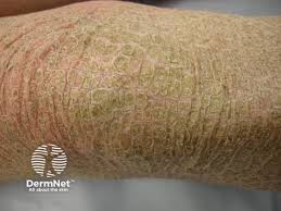 Image result for Ichthyosis