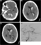 Image result for icd-10 code for traumatic intraparenchymal hemorrhage