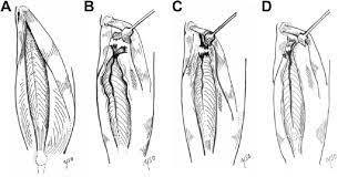 Schematic Illustrations Of Different Proximal Rectus Femoris Tear Download Scientific Diagram