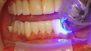 Something like short term ortho can straighten a lot of teeth. Veneers Or Braces Which Treatment Should You Get For Straightening Crooked Teeth