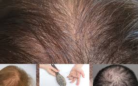 Vous constatez que vous perdez de plus en plus de cheveux et vous êtes tout le temps angoissé à l'idée d'avoir le crâne complètement dégarni ? Comment Eviter De Perdre Ses Cheveux Et Lutter Contre La Calvitie