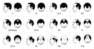It is commonly used and there are some reports of hair loss associated with this drug, however, at the age of 17, you might be seeing the early maturation of your hairline and you should want to get your hair mapped out for miniaturization to be sure that you do not have genetic balding. Hair Loss From Ssris Wrassman M D Baldingblog