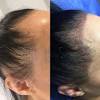 Hairstyles To Hide Hair Loss