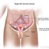 Symptoms of ovarian cancer can appear at any stage, they tend to develop in the later stages. Https Encrypted Tbn0 Gstatic Com Images Q Tbn And9gcrvu8mvowfnvb81evfrl2ttzopkfd7puuv2iewdm Lj2xhsaimi Usqp Cau