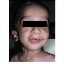 Deviation of mouth with absence of nasolabial fold