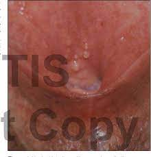 Onlar endişe edilecek bir durum var mı? Pdf Vestibular Papillomatosis A Benign Condition Mimicking Genital Warts Semantic Scholar