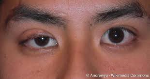 Durch den lidschlag wird die tränenflüssigkeit gleichmäßig über die hornhaut verteilt. Ptosis Ursachen Behandlungsmoglichkeiten Risiken Netdoktor
