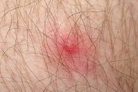 Image result for infected tick bite