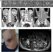 Transverse Process Fractures A Clinical Series And Coronal Injury Of The Spine Sciencedirect