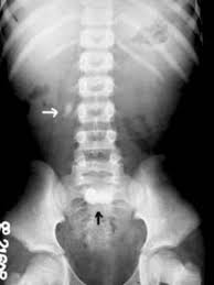 Plain X Ray Kub Showing A Single Stone On The Right Side White Arrow Download Scientific Diagram
