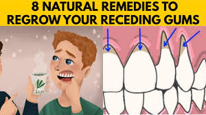 Can baking soda remineralize teeth? 8 Easy Ways To Grow Back Your Receding Gums Naturally At Home Youtube