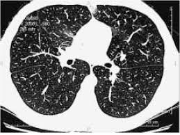 Scanner thoracique sans injection de produit de contraste. Scanner Thoracique Coupes Parenchymateuses Sans Injection De Produit Download Scientific Diagram